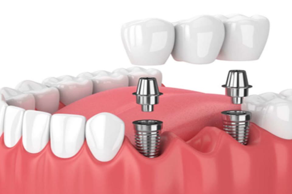 Illustration of a dental bridge supported by implants
