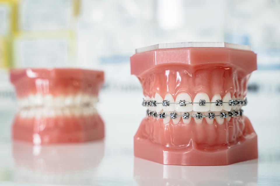 Metal dental braces on a teeth model