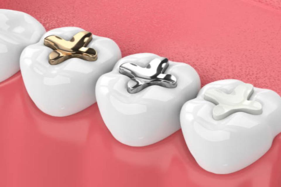Illustration of gold, silver and tooth-coloured dental fillings