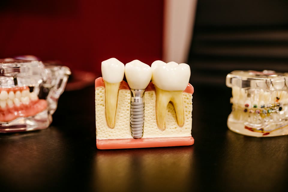 Dental implant model showing the implant, abutment and crown