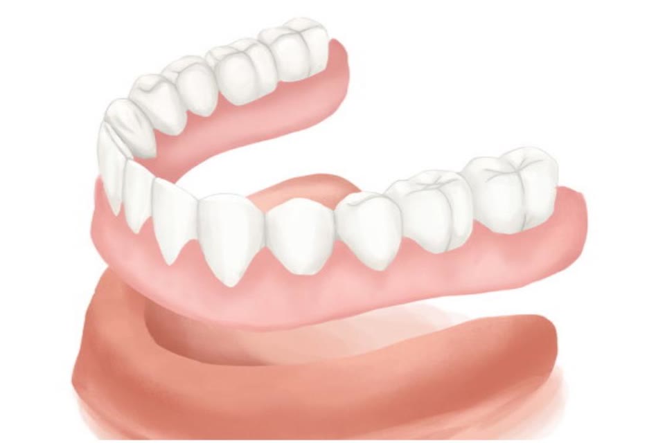 Illustration of complete dentures