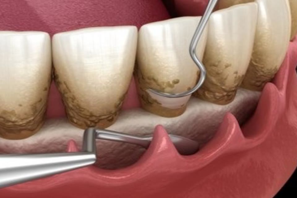 Illustration of gum disease treatment with dental instruments