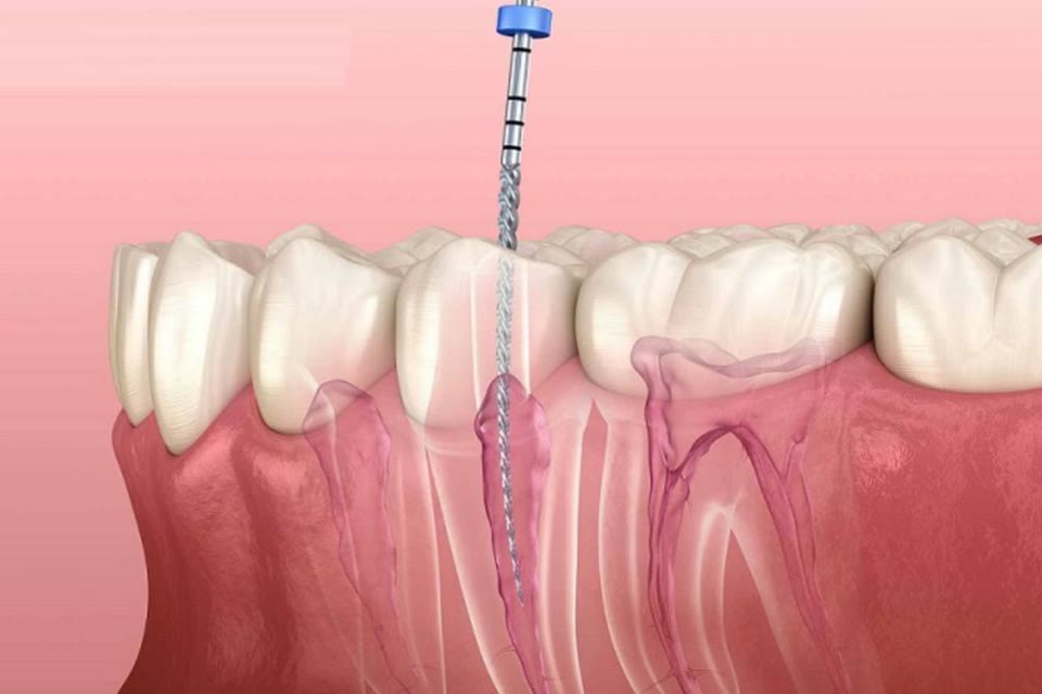 Illustration of root canal treatment inside a tooth