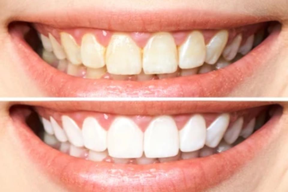 Teeth before and after whitening